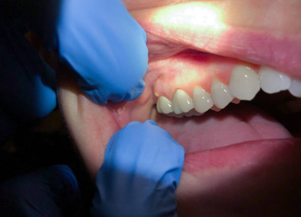 Best Emergency Wisdom Teeth Removal in North Bennington, VT