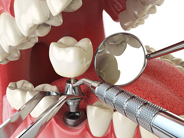 Best Emergency Tooth Extraction in North Bennington, VT